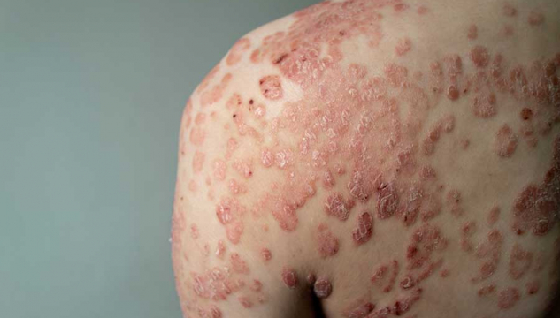 Psoriasis